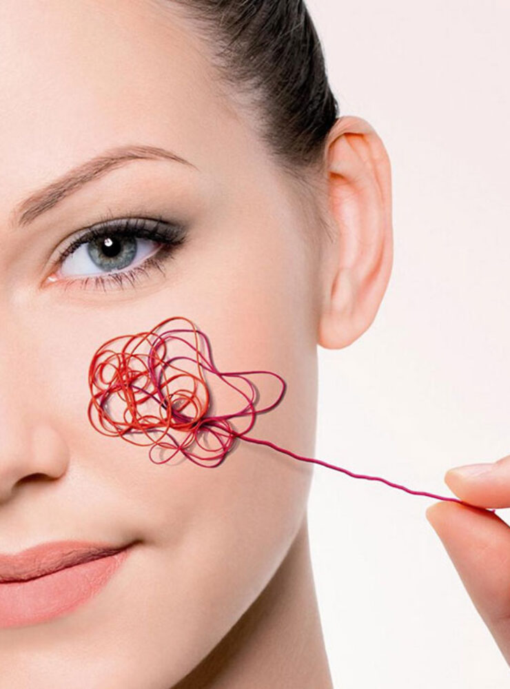 Arañas vasculares faciales