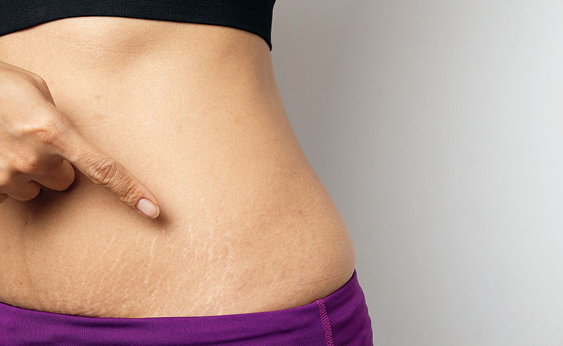 Tratamiento estrías