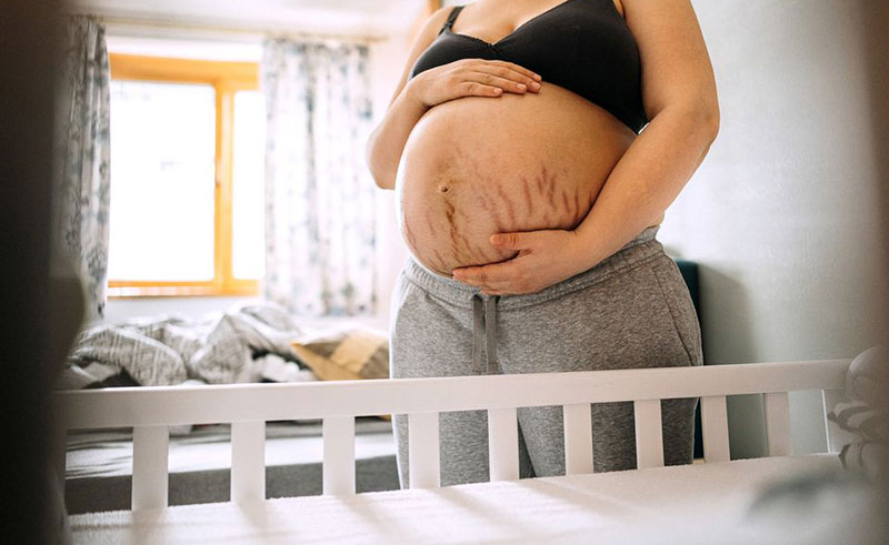 Tratamiento estrías